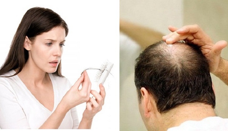 Tổng hợp 7 Nguyên nhân gây rụng tóc ở nam giới