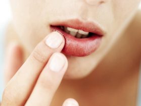 Chàm môi là gì? Nguyên nhân, triệu chứng và cách chữa trị 