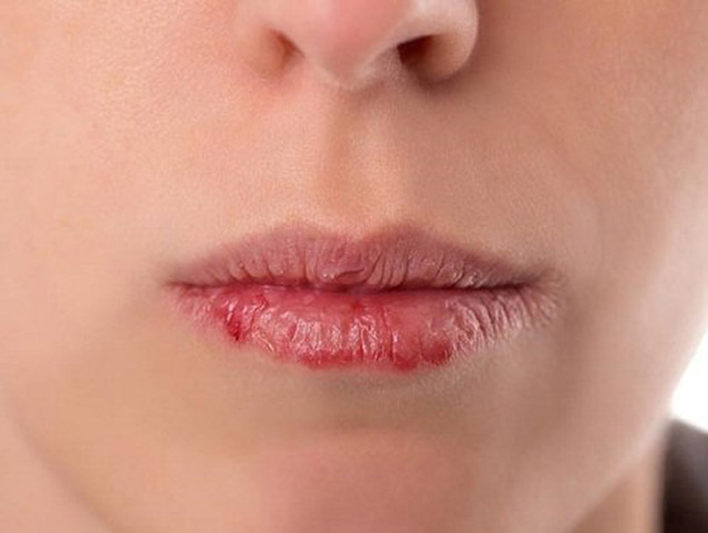 Chàm môi gây đau đớn và khó chịu cho nhiều người