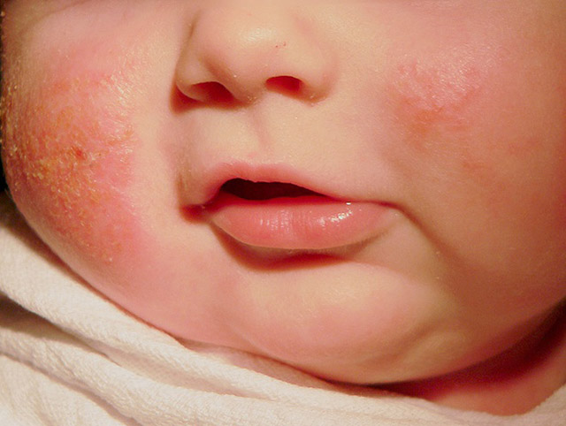Chàm sữa thường xuất hiện ở vùng mặt, trán, cổ và má của trẻ sơ sinh