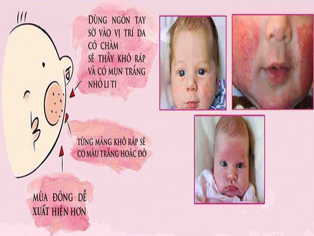 Các dấu hiệu chàm sữa ở trẻ sơ sinh dễ bị nhầm lẫn với nẻ nên các mẹ cần hết sức lưu ý
