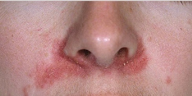 Người bệnh cảm thấy da có hiện tượng ngứa, xuất hiện nhiều mảng đỏ, da bong tróc