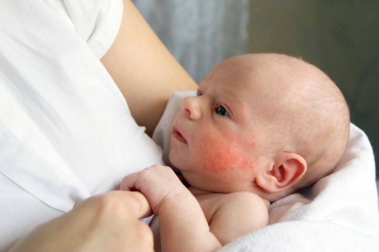 Trẻ bị viêm da tiếp xúc xuất thường xuất hiện sớm từ 2 - 3 tháng tuổi