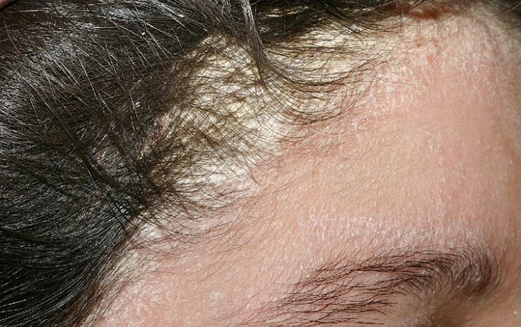 Vùng da đầu cũng là vị trí dễ bị mắc bệnh