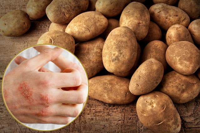 Cách chữa chàm bằng khoai tây vô cùng đơn giản