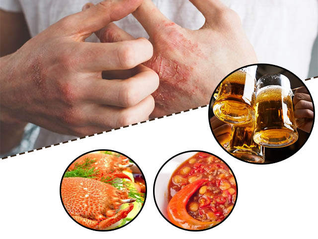 Người bệnh chàm khô nên chú ý trong ăn uống, tránh một số món ăn có thể gây kích ứng da