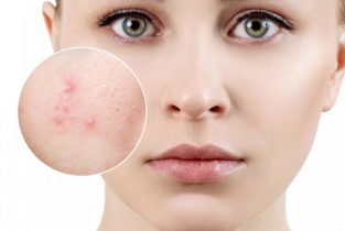 Chăm sóc da thường xuyên giúp loại bỏ được mụn ẩn dưới da