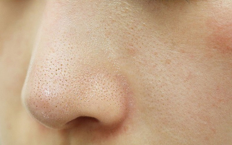 Nguyên nhân gây mụn cám có thể do vệ sinh da không sạch sẽ