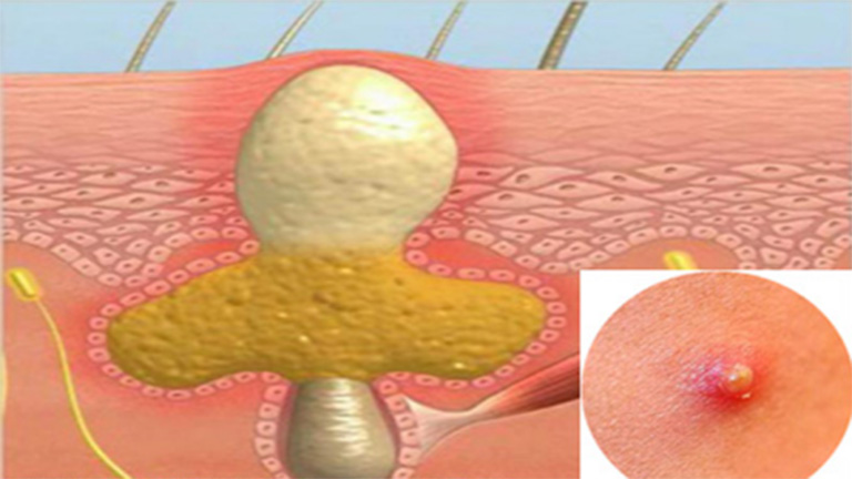 Viêm nang lông là 1 trong những nguyên nhân phổ biến gây mụn nhọt ở mông