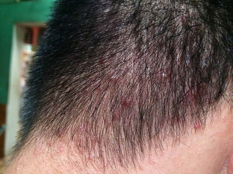 Mụn trên đầu là triệu chứng của một số bệnh lý da đầu