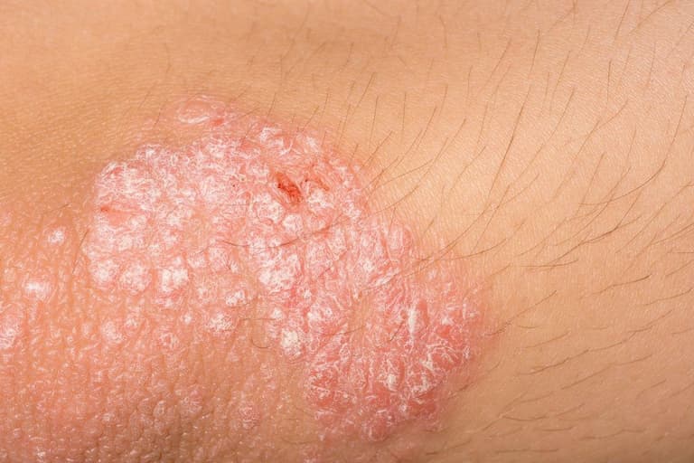 Eumovate được chỉ định dùng trị các bệnh ngoài da