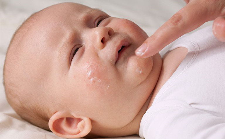Thoa kem dưỡng ẩm để bổ sung độ ẩm chăm sóc làn da của con trẻ