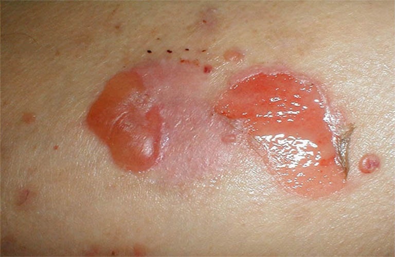 Viêm da tiếp xúc bội nhiễm là một trong những bệnh lý da liễu khá nguy hiểm 