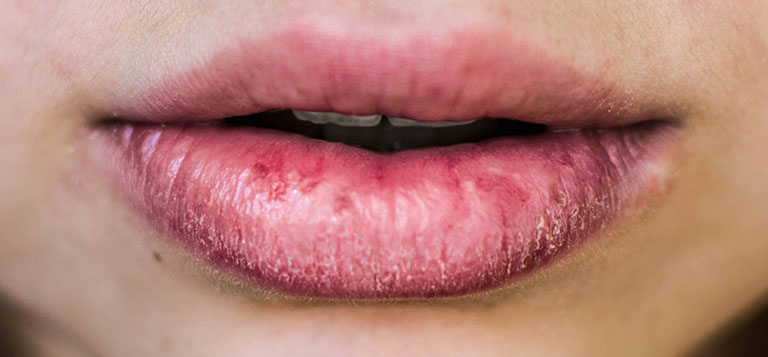 Bệnh chàm môi gây ngứa rát