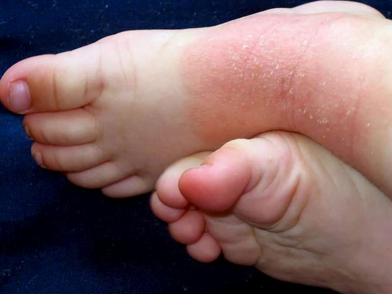 Bệnh vảy nến ở tay chân không gây nguy hiểm sức khỏe nhưng làm mất tính thẩm mỹ