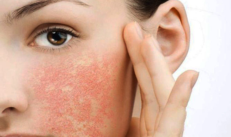 Da mặt bị ngứa nổi mẩn có nguy hiểm không?