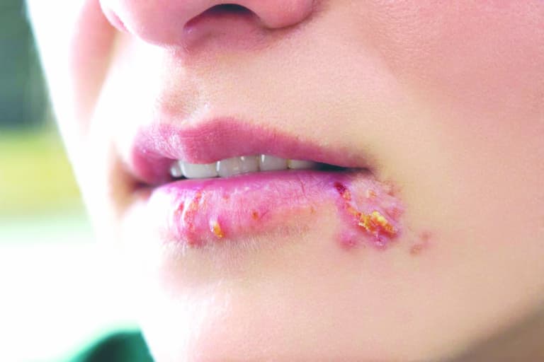 Herpes ở môi cũng là nguyên nhân gây bệnh
