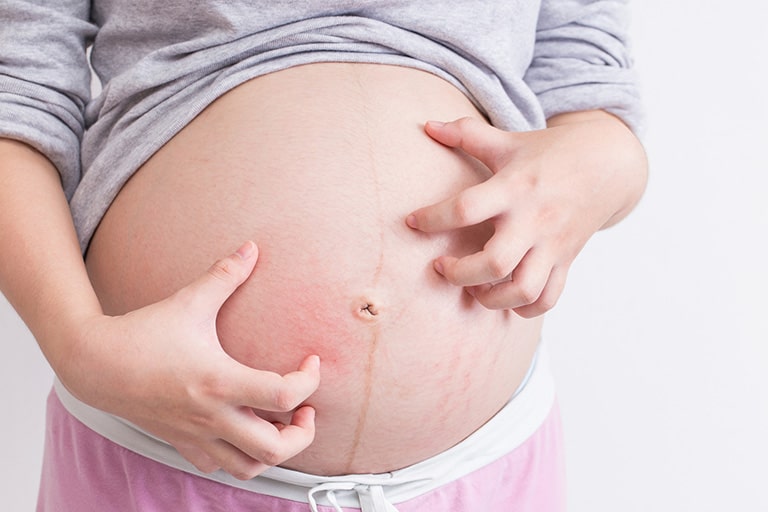 Khi mang thai, hệ miễn dịch suy giảm làm tăng nguy cơ mắc bệnh viêm da cơ địa ở bà bầu