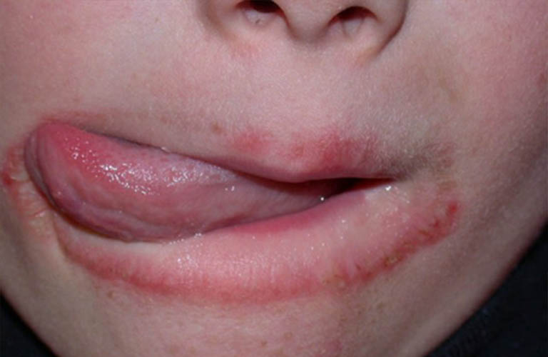 Nguyên nhân gây ngứa quanh miệng là gì?