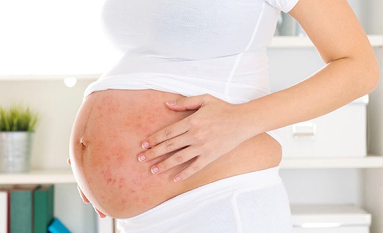 Phụ nữ mang thai là một trong những đối tượng rất dễ bị viêm da cơ địa