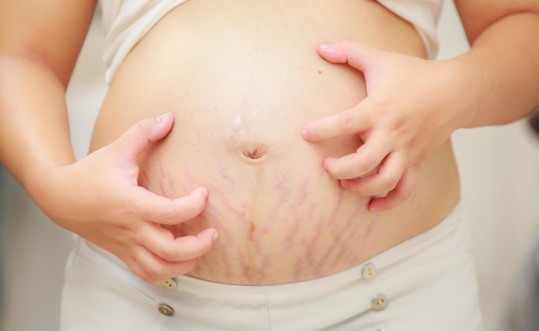 Rạn da cũng gây ngứa ở phụ nữ mang thai