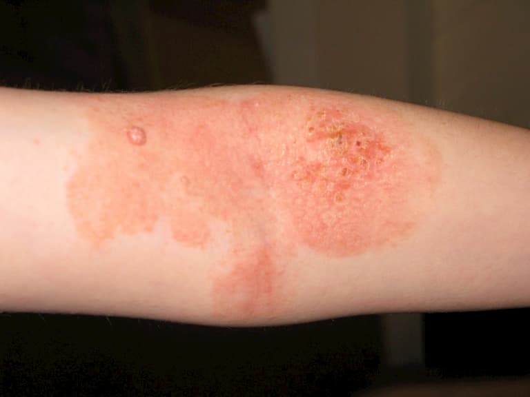 Viêm da tiếp xúc cũng được xem là một trong những nguyên nhân gây bệnh