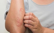 Viêm da tiếp xúc cũng là một trong những nguyên nhân gây bệnh