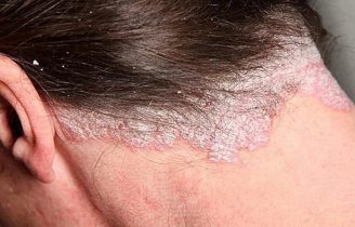 Bệnh á sừng da đầu nguyên nhân và cách chữa