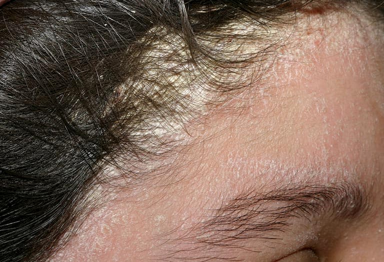 Da đầu ngứa có vảy trắng nguyên nhân có thể do bệnh vảy nến