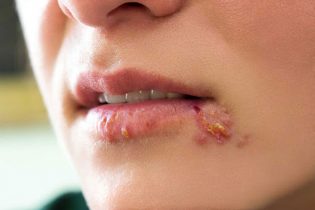 Mụn rộp môi miệng gây khó chịu cho người bệnh