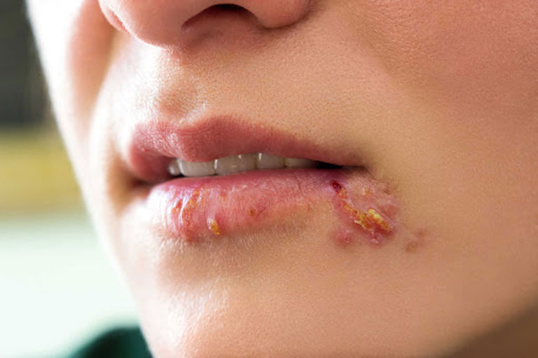 Mụn rộp môi miệng gây khó chịu cho người bệnh