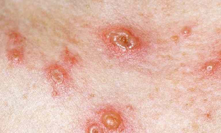 Nhiễm trùng da là biến chứng thường gặp nếu bệnh không điều trị bệnh dứt điểm