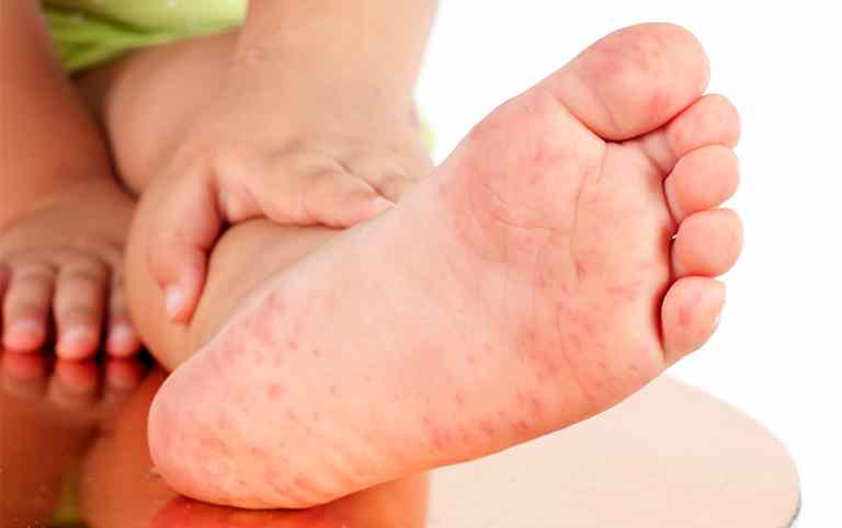 Nổi mề đay ở tay chân là một trong những dạng tổn thương da khá phổ biến