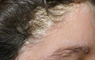 Viêm da dầu ở đầu nguyên nhân và cách điều trị