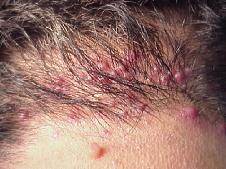 Viêm nang lông vùng da đầu