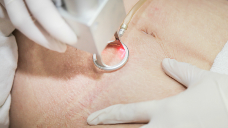 Thủ thuật phòng khám bằng laser trị rạn da đều có mặt tại các spa, trung tâm trị liệu