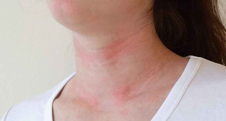 Nổi mề đay ở cổ là tình trạng vùng da cổ xuất hiện các nốt mẩn đỏ gây cảm giác ngứa ngáy