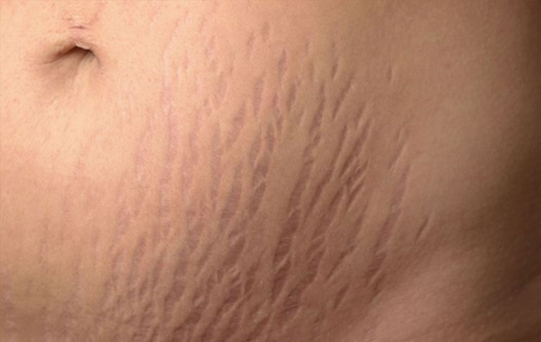 Các vết rạn sờ vào thấy lõm, có phân chia ranh giới rõ ràng với các vùng da xung quanh