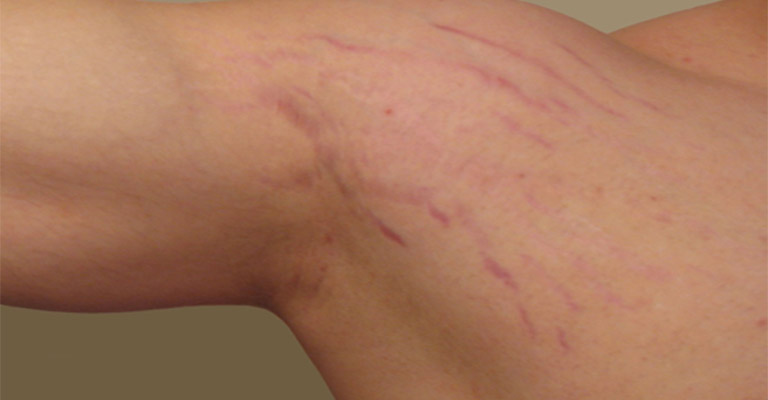 Các vết rạn sẽ xuất hiện tại vùng da bị căng giãn trong thời gian dài