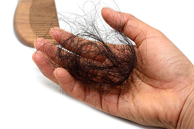 Tóc rụng nhiều thường do một số yếu tố bệnh lý gây ra