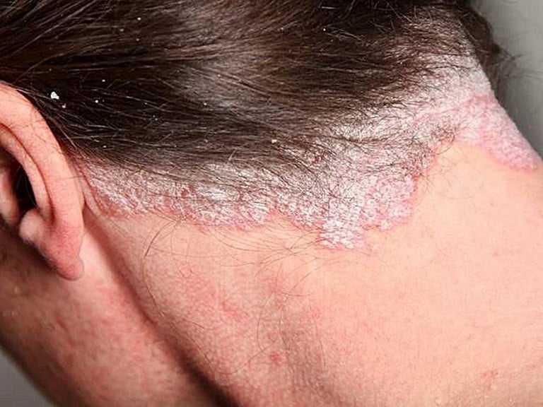 Bệnh vẩy nến da đầu: Nguyên nhân, triệu chứng và cách điều trị 2023