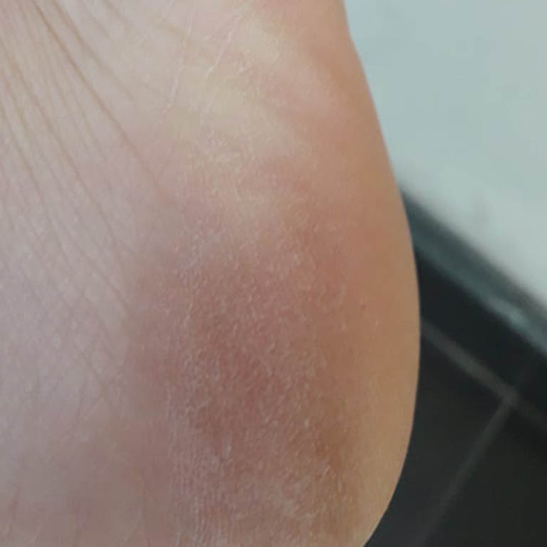 Hình ảnh gót chân của Phương sau khi dùng bài thuốc An Bì Thang giải quyết á sừng