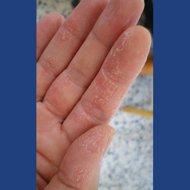 Hình ảnh bàn tay của chị Hương Lan trước khi dùng bài thuốc An Bì Thang