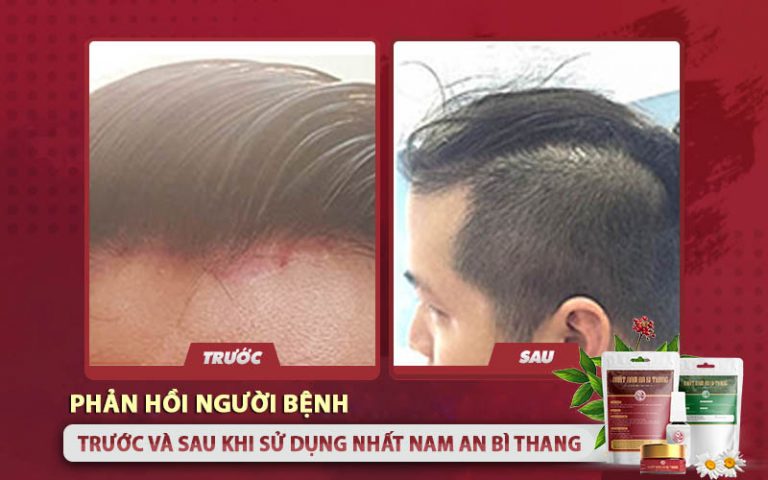 Tình trạng da dầu của Lê Nam trước và sau khi dùng Nhất Nam An Bì Thang