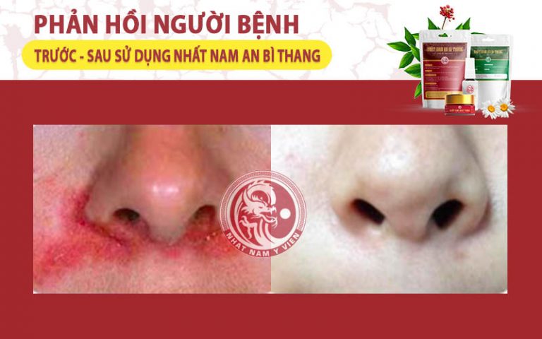 Hình ảnh trước và sau điều trị của chị Nguyễn Mai