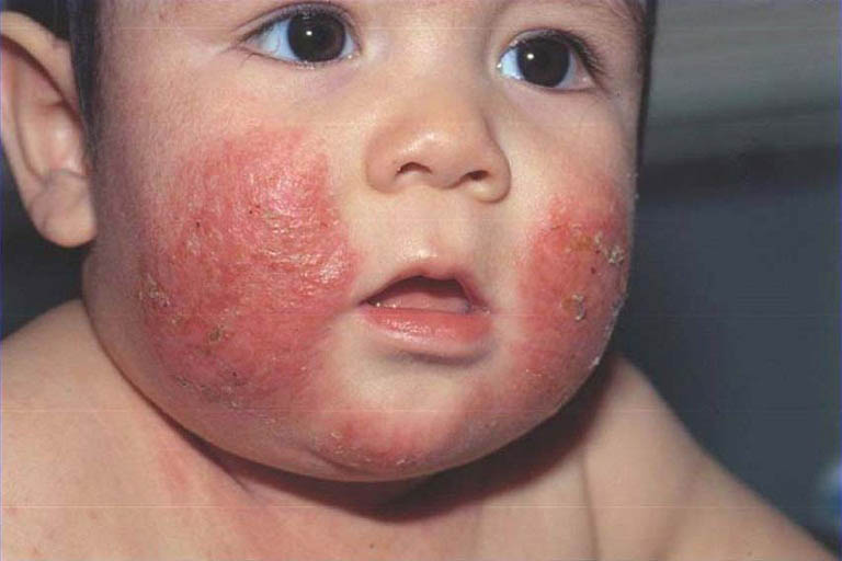 Chàm với những triệu chứng ngoài da khiến trẻ khó chịu