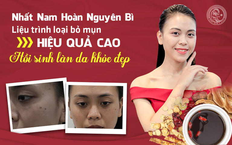 Làn da của chị Trang đã được hồi sinh trở lại sau khi kết thúc liệu trình hỗ trợ điều trị mụn tại Trung tâm Da liễu Đông y Việt Nam