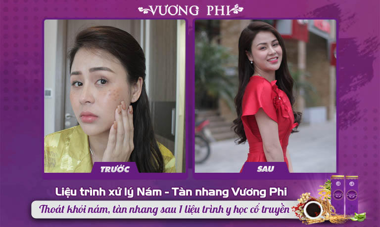 Diễn viên Lương Thu Trang trước và sau khi sử dụng Liệu trình xử lý nám Vương Phi