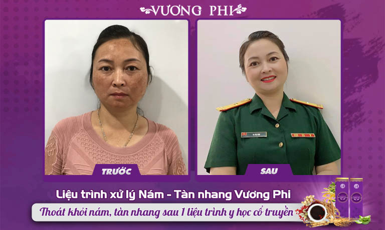 Thiếu tá Tạ Thị Vân đã không còn lo lắng vì nám má lâu năm