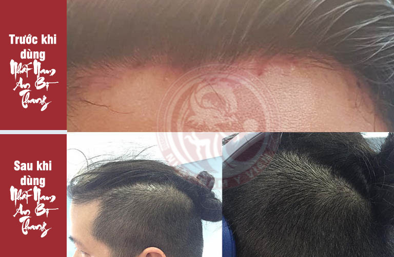 Tình trạng da đầu trước và sau khi dùng Nhất Nam An Bì Thang của khách hàng